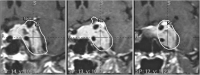 Abbildung 2: Gamma-Knife-Dosisplan