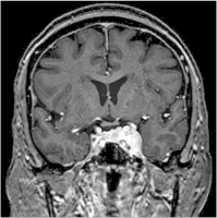 Abbildung 3: Sinus-cavernosus-Meningeom
