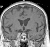 Abbildung 6: Sinus-cavernosus-Meningeom