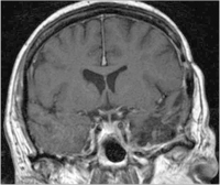 Abbildung 8: Sinus-cavernosus-Meningeom