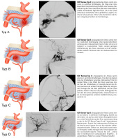 Abbildung 1: Karotis-Sinus-cavernosus-Fistel