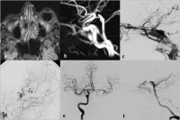 Abbildung 5a-f: Karotis-Sinus-cavernosus-Fistel