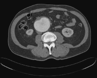 Abbildung 1: Aortenaneurysma