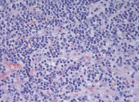 Abbildung 3: Lymphom