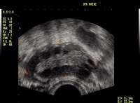 Abbildung 2: PCOS