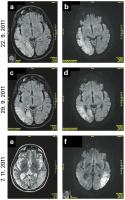 Abbildung 1a-f: MELAS-Syndrom