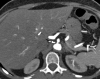 Abbildung 1a: MDCT-Angiographie
