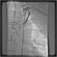 Abbildung 5: Catheter-Induced Dissection