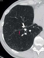 Abbildung 3: Computertomographie-COPD