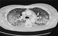 Abbildung 2: Eosinophilie