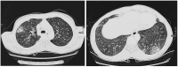 Abbildung 3: Eosinophilie