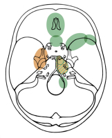 Figure 3: Intracranial Meningioma