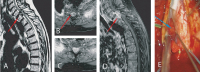 Figure 1a-e: Spinal Meningioma