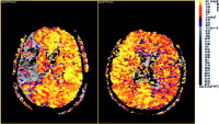Abbildung 1: Schlaganfall-Neuroimaging
