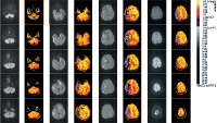 Abbildung 2: Schlaganfall-Neuroimaging