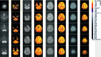 Abbildung 3: Schlaganfall-Neuroimaging