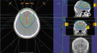 Figure 1-a: Radiotherapy - Meningioma