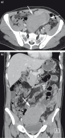 Abbildung 1a-b: Dünndarm - Tumor