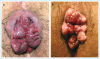 Abbildung 1a-b: Hämorrhoiden
