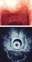 Abbildung 1: Submukosaler Tumor