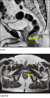 Abbildung 4: Submukosaler Tumor