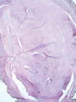 Abbildung 6: Submukosaler Tumor