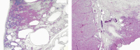 Abbildung 2a-b: Krukenberg-Tumor