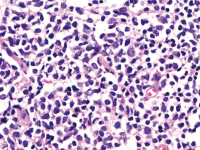 Abbildung 4b: Follikuläres Lymphom