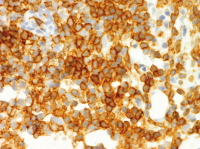 Abbildung 4c: Follikuläres Lymphom
