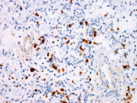 Abbildung 4d: Follikuläres Lymphom