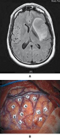 Figure 2A-B: Awake Craniotomy