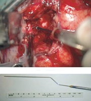 Figure 4: Awake Craniotomy