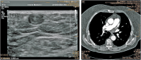 Abbildung 1: Venenthrombose