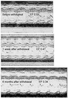 Figure 5: Betablocker - Phonokardiographie