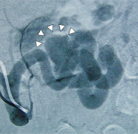 Abbildung 4: Sacciformes Aneurysma
