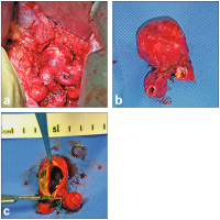 Abbildung 5a-c: Sacciformes Aneurysma