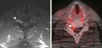 Figure 2a-b: Primary neurolymphomatosis