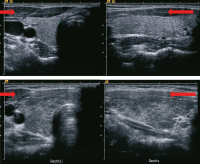 Abbildung 4: Chronische Immunthyreoiditis