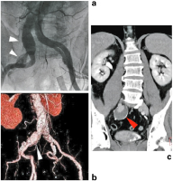 Abbildung 5: Iliakalaneurysma