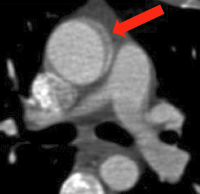Abbildung 1: Aorta ascendens