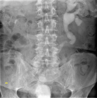 Abbildung 2: Implantationsstenose