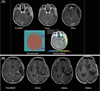 Figure 2a-b: GBM patient