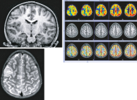 Figure 1a-c: Angiocentric glioma