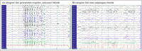 Abbildung 2: EEG - Ketogene Diät