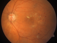 Abbildung 2: Diabetische Retinopathie