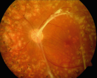 Abbildung 3: Diabetische Retinopathie