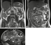 Abbildung 1a-c: Appendizitis-Diagnose