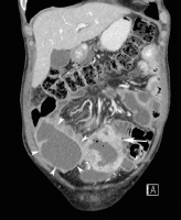 Abbildung 2b: MDCT - 3D
