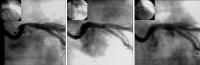 Figure 1: Koronararterienintervention
