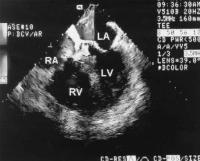 Figure 1: Sinus-Valsalvae-Aneurysma
